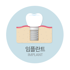 임플란트